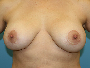 Breast Implant Exchange Before